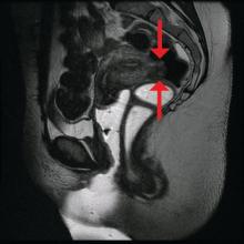 This patient's MRI shows a smaller rectosigmoid endometriotic nodule that was removed through a discoid resection.